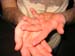 noah's bass blisters